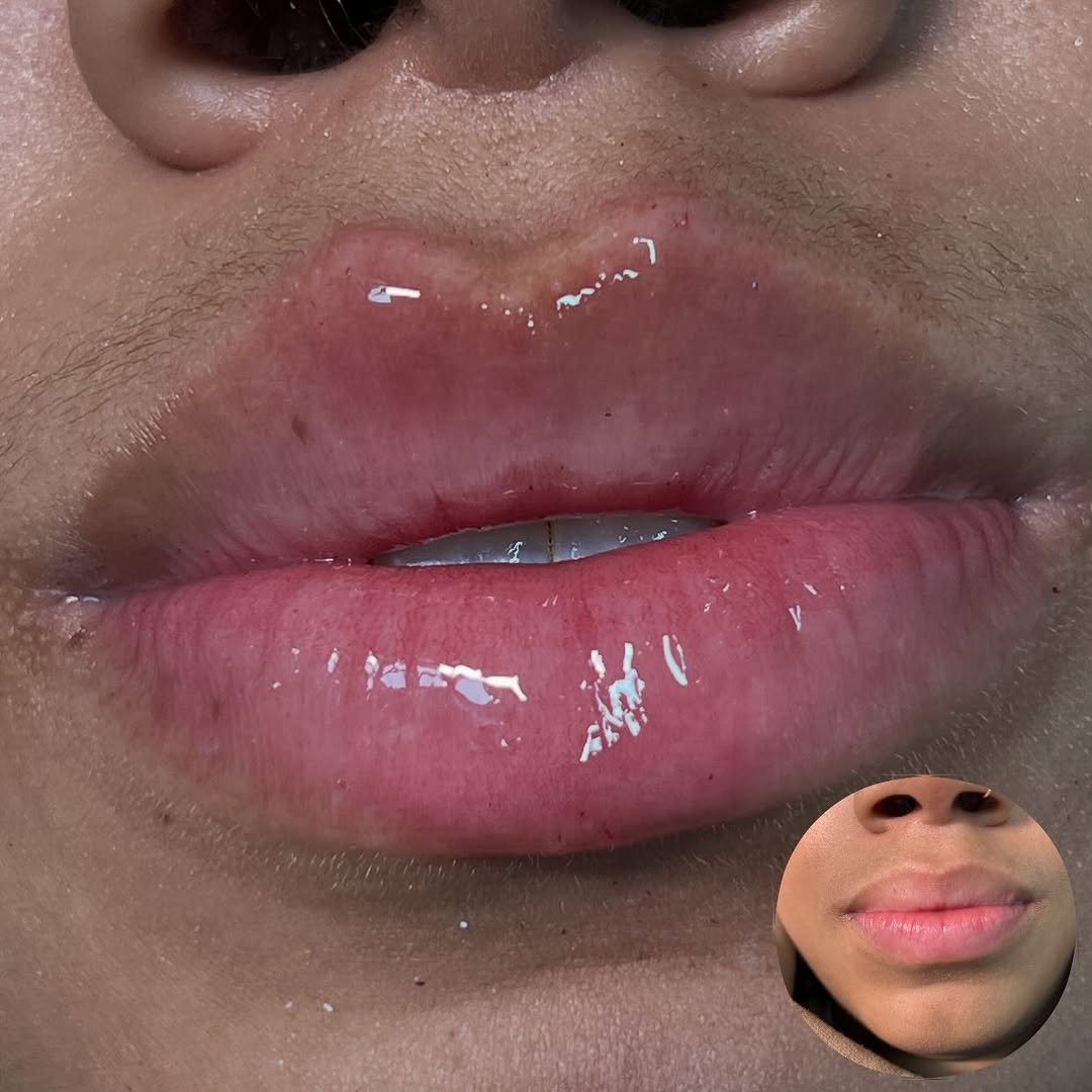 Natural enhancement