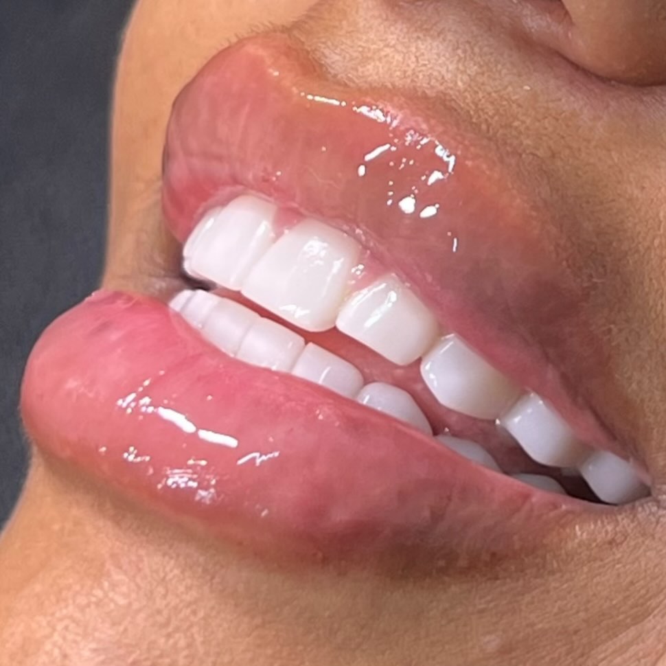 A settled 1ml lip filler result