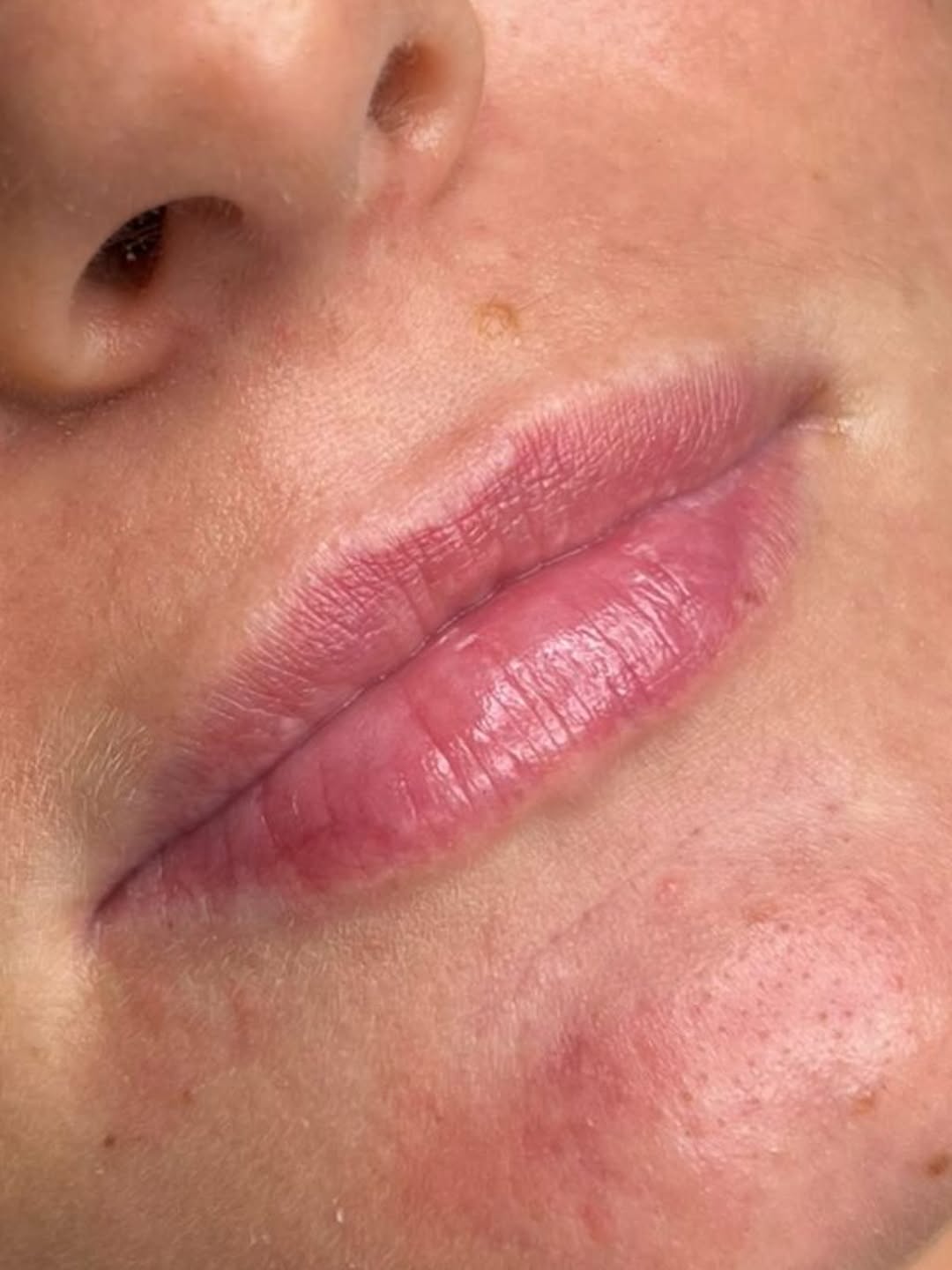 Before — Lip filler · 1ml